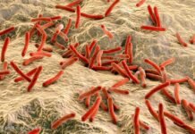 Leprosy: A Brief Overview